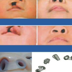 Nostril Retainers (Nasal Confirmer)